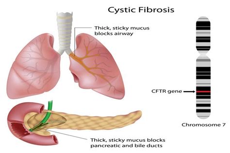 cystic fibrosis overview symptoms causes treatment complications