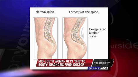 Mid South Doctor Gives “ghetto Booty” Diagnosis