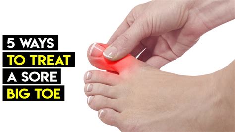 swollen toe  ways  treat  sore big toe naturally youtube