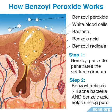 benzoyl peroxide work   skin acneorg