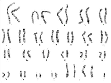 Chromosome Karyotyping Shows 49 Xxxxy Download Scientific Diagram
