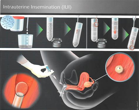 teen insemination