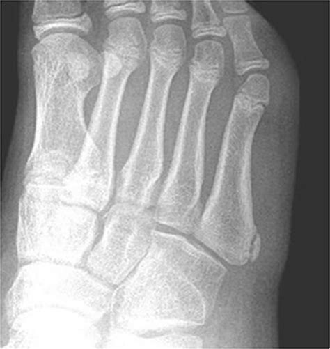 Differentiating Types Of 5th Metatarsal Fractures Rcemlearning India