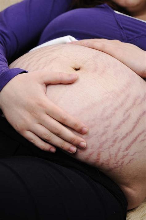 Causes And Treatments For Stretch Marks Healthy Pregnancy