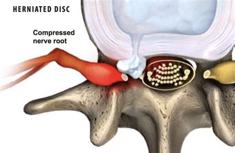 herniated disc   symptoms   herniated disc