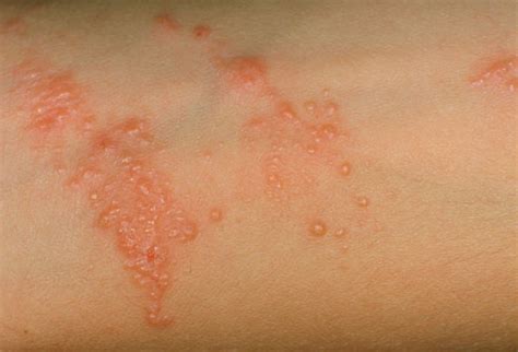 fungal rash  symptoms treatment pictures infection health