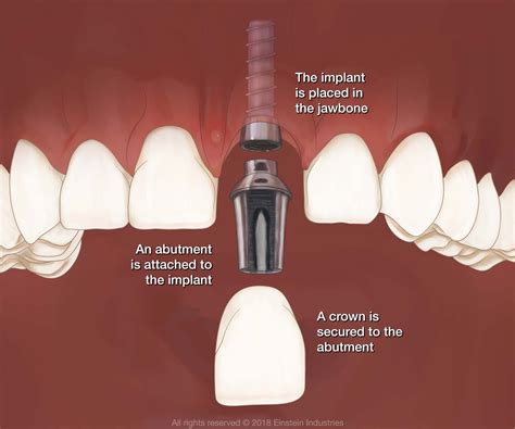 distinct parts    implant supported restoration replacing  tooth  root