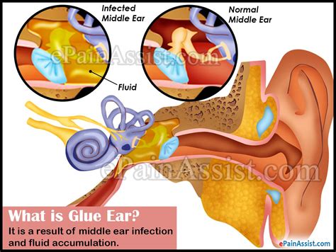 glue ear or otitis media with effusion ome causes