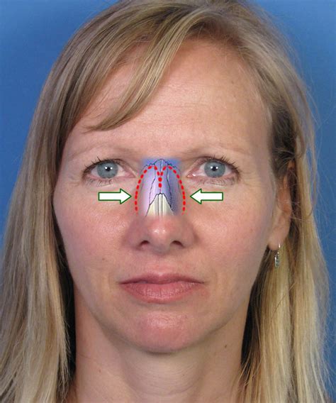 osteotomies  narrow  nasal bridge dr hilinski