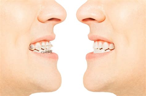 Choosing Between Invisalign And Traditional Braces