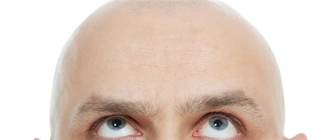 Why Do Men Go Bald From The Top Of Their Heads Bbc Science Focus