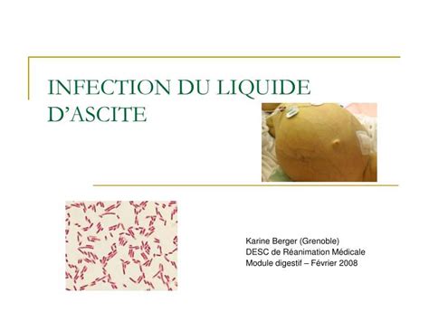 Ppt Infection Du Liquide Dascite Powerpoint Presentation Id 223047