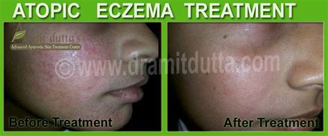 Atopic Eczema Ayurvedic Skin Treatments In Punjab India