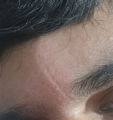 Scar On Forehead Scar Treatments