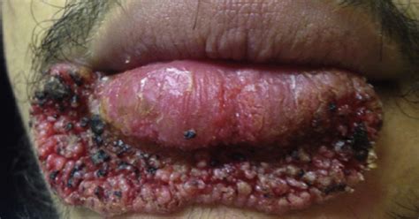 Construction Worker Pops Pimple Develops Yeast Growth