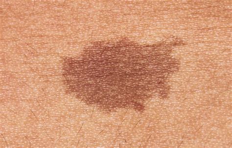 brown spots  skin arms hot sex picture