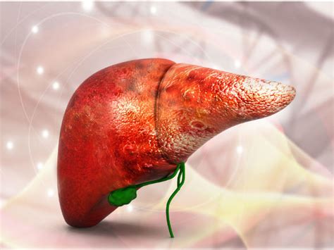 alcoholic liver disease causes stages symptoms risk