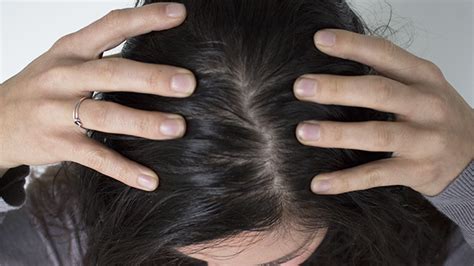 types  scalp disorders