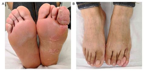 proteus syndrome   foot  case report  literature review
