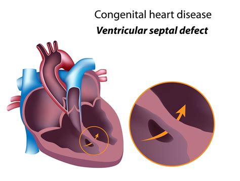 congenital heart defects diagram  heart illustrating  structures