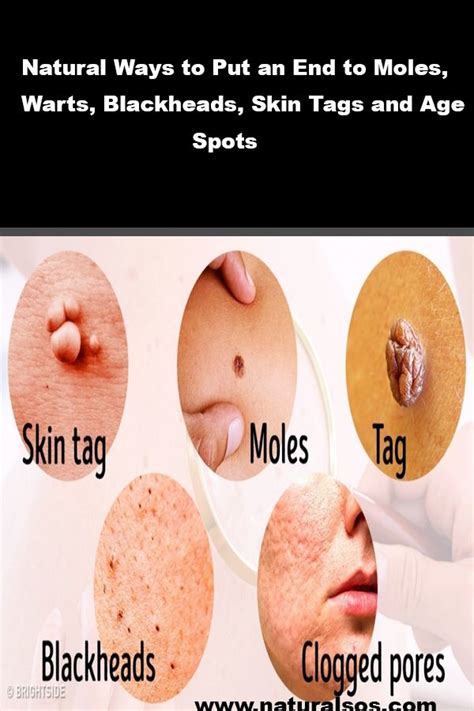 natural ways to put an end to moles warts blackheads