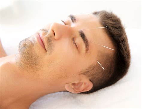 acupuncture proven effective  migraine relief
