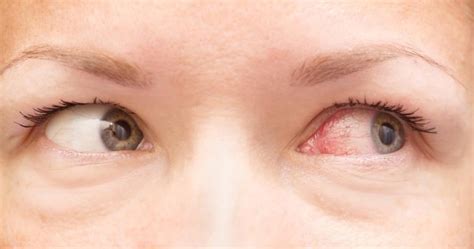 long  pink eye  symptoms treatment prevention
