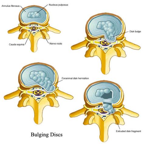 bulging disc  neck painful spine conditions   neck