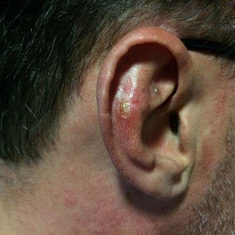 cancer   external ear types symptoms staging  treatment