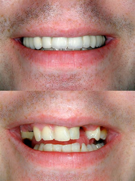 important  replace missing teeth smile essentials