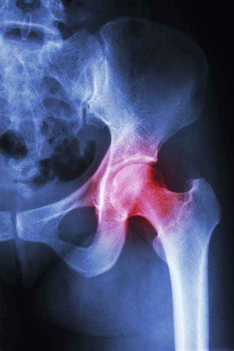 ways  treat hip arthritis