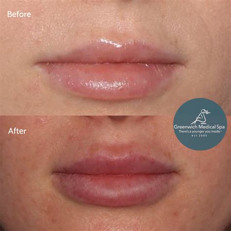 lip injections lip injections medical spa lips