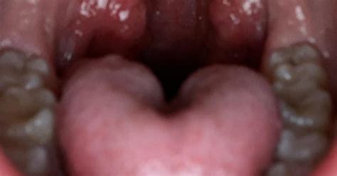 Tonsils Are Swollen Again After Having Oral Sex I Had A Peritonsillar