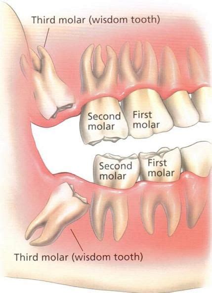 Is It Safe To Have All Four Wisdom Teeth Removed At Once News
