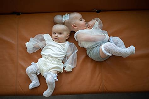 nine month old conjoined twins by head separated successfully