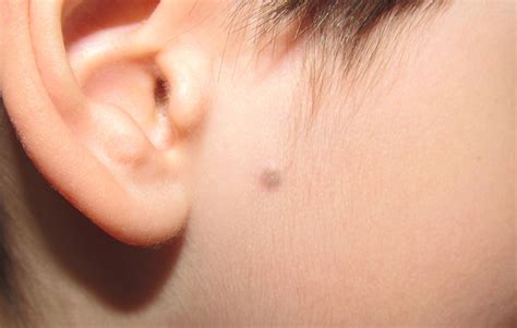 epidermal cyst   face   child clinically  dermoscopically mimicking pilomatricoma