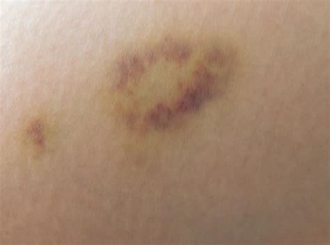 yellow bruise   breast  home remedies  skin
