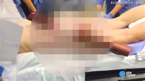 woman impaled in buttocks after texting while driving