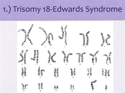 Ppt Karyotype And Genetic Disorders Powerpoint Presentation Free
