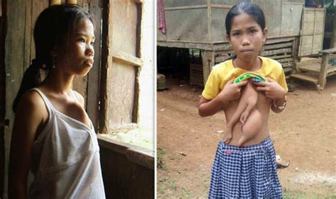 philippines news schoolgirl who grew extra limbs on her