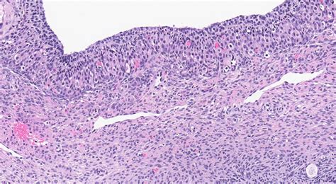 pathology outlines follicle cyst