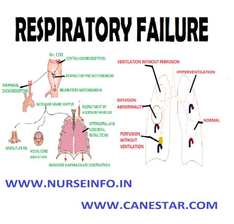 respiratory failure nurse info
