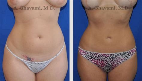liposuction before and after photos in beverly hills dr