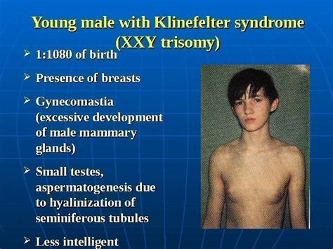 Does Tom Cruise Have Klinefelter Syndrome 💖office C303 Teaching