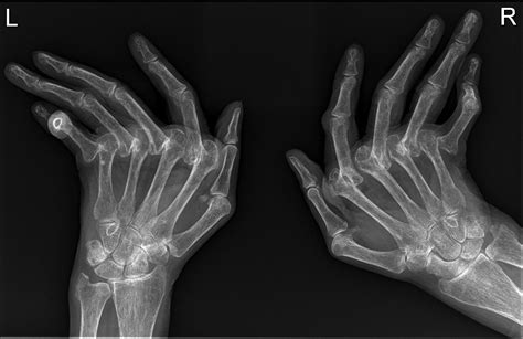 rheumatoid arthritis hands radiology  st vincents university