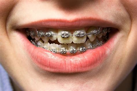 cost   dental braces  invisalign  singapore