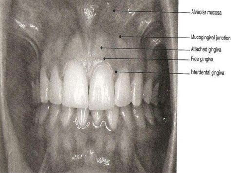 clinical features  gingiva