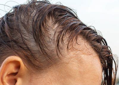 covid  survivors report experiencing hair loss hair loss