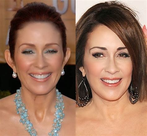 Has Patricia Heaton Had Plastic Surgery Done Before And