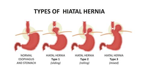 hernia hiatalis middenrifbreuk integraal medisch centrum